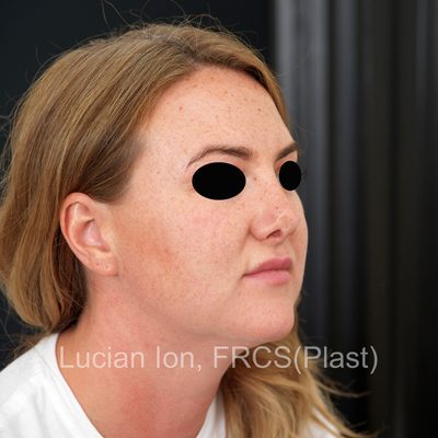 Before secondary rhinoplasty, case 1, oblique view