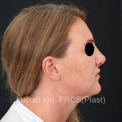 Before secondary rhinoplasty, case 1, profile view