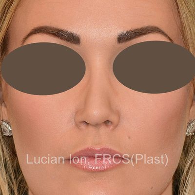 Before secondary rhinoplasty, case 2, front view