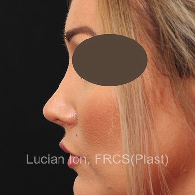 After secondary rhinoplasty, case 2, profile view