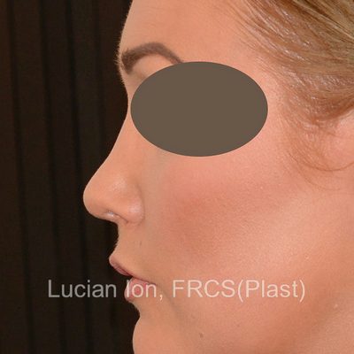 Before secondary rhinoplasty, case 2, profile view