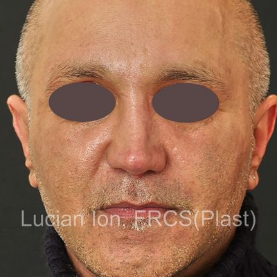 After secondary rhinoplasty, case 3, front view