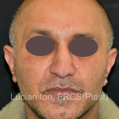 Before secondary rhinoplasty, case 3, front view