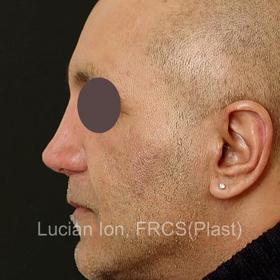 After secondary rhinoplasty, case 3, profile view