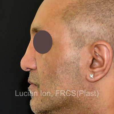 Before secondary rhinoplasty, case 3, profile view