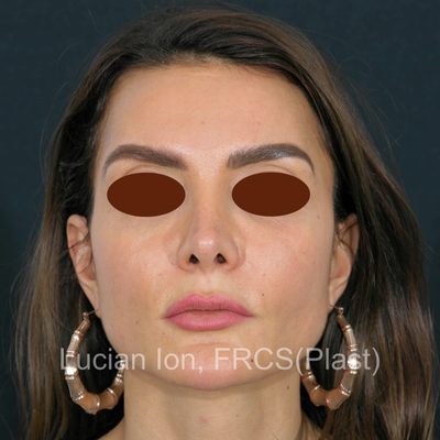 After secondary rhinoplasty, case 4, front view