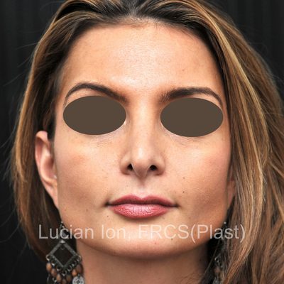 Before secondary rhinoplasty, case 4, front view