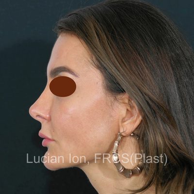 After secondary rhinoplasty, case 4, profile view