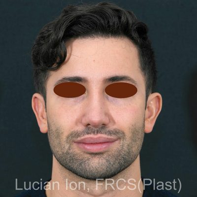 After secondary rhinoplasty, case 5, front view