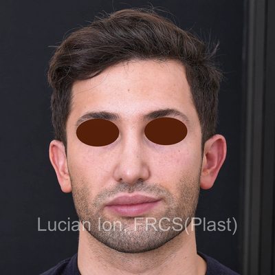 Before secondary rhinoplasty, case 5, front view