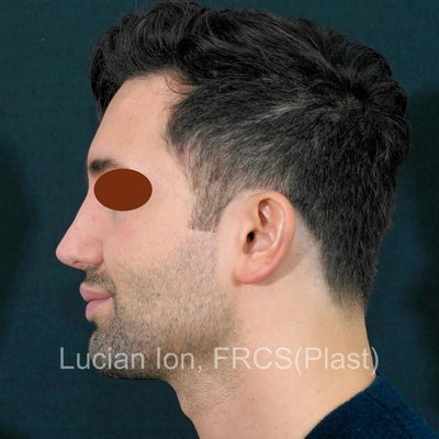 After secondary rhinoplasty, case 5, profile view