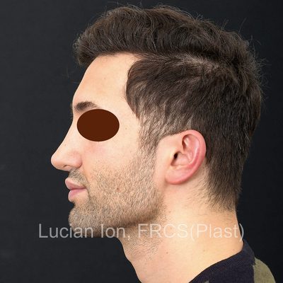 Before secondary rhinoplasty, case 5, profile view
