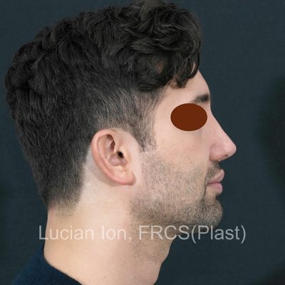 After secondary rhinoplasty, case 5, profile view