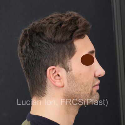 Before secondary rhinoplasty, case 5, profile view