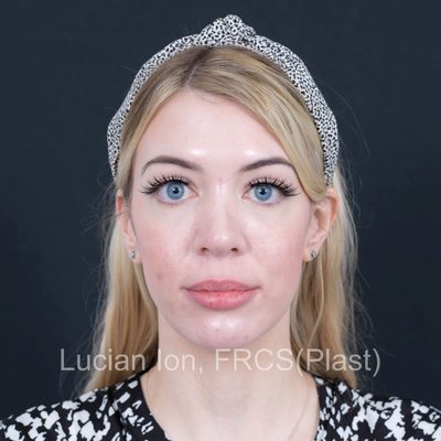 After secondary rhinoplasty, case 6, front view