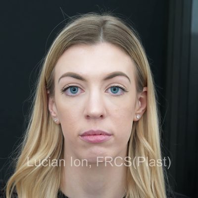 Before secondary rhinoplasty, case 6, front view