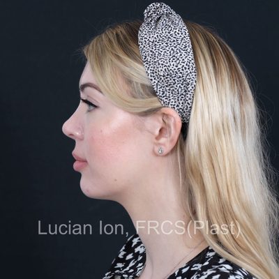 After secondary rhinoplasty, case 6, profile view