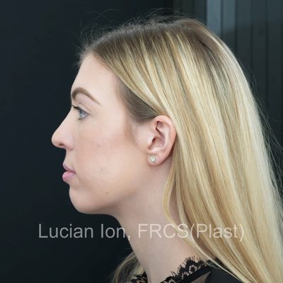 Before secondary rhinoplasty, case 6, profile view