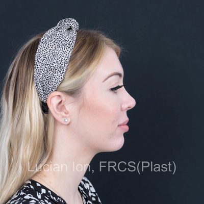 After secondary rhinoplasty, case 6, profile view
