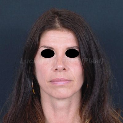 After secondary rhinoplasty, case 7, front view