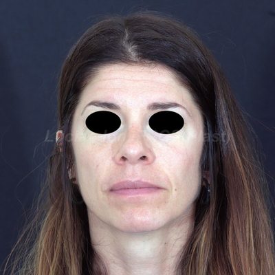 Before secondary rhinoplasty, case 7, front view
