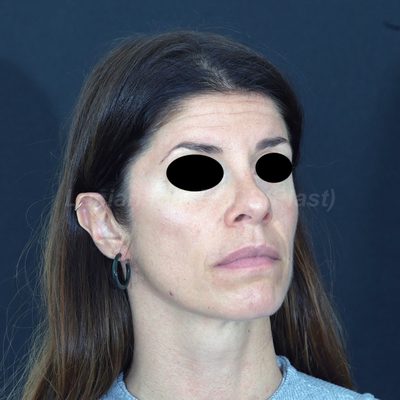Before secondary rhinoplasty, case 7, oblique view