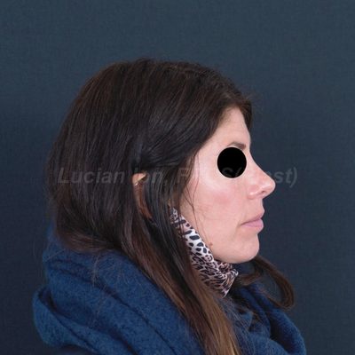 After secondary rhinoplasty, case 7, profile view