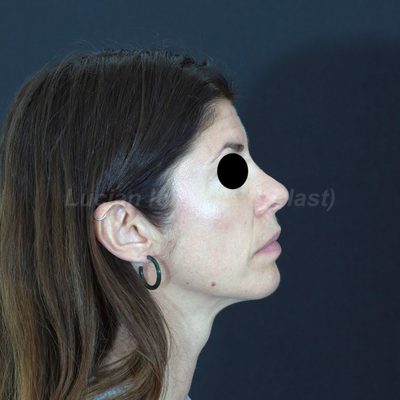 Before secondary rhinoplasty, case 7, profile view