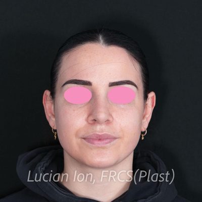 After secondary rhinoplasty, case 8, front view