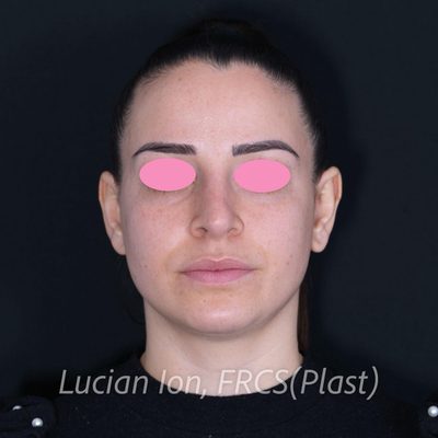 Before secondary rhinoplasty, case 8, front view
