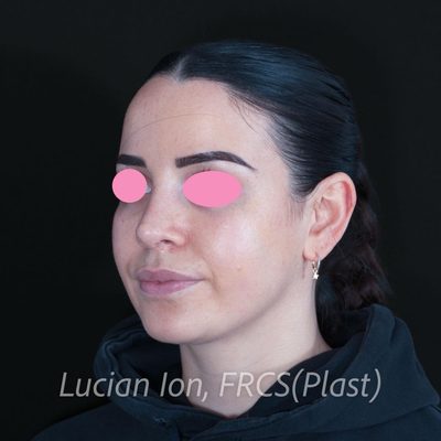 After secondary rhinoplasty, case 8, oblique view