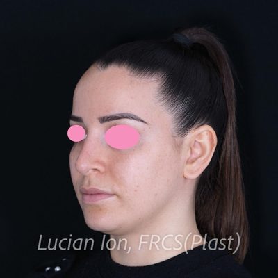 Before secondary rhinoplasty, case 8, oblique view