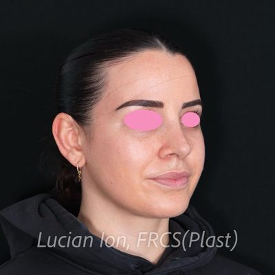 After secondary rhinoplasty, case 8, oblique view