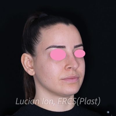 Before secondary rhinoplasty, case 8, oblique view