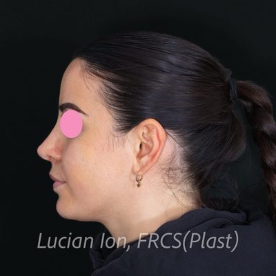 After secondary rhinoplasty, case 8, profile view