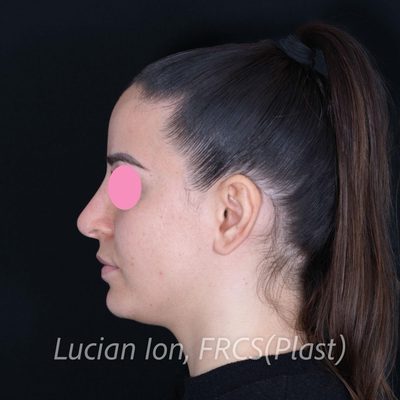 Before secondary rhinoplasty, case 8, profile view