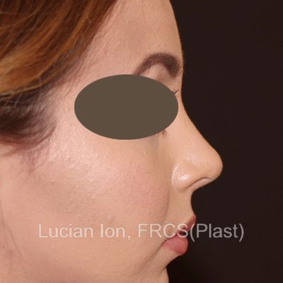 After , case 2, profile view