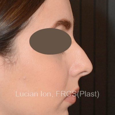 Before , case 2, profile view