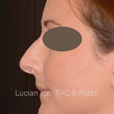 Before , case 3, profile view