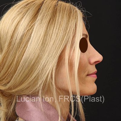 After , case 4, profile view