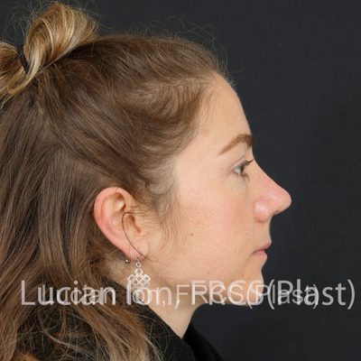 After , case 5, profile view