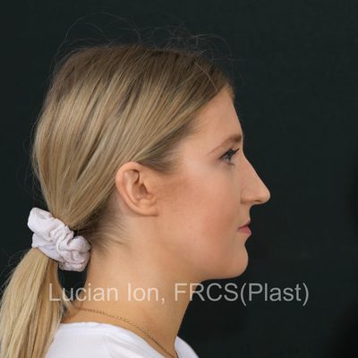 Before , case 6, profile view