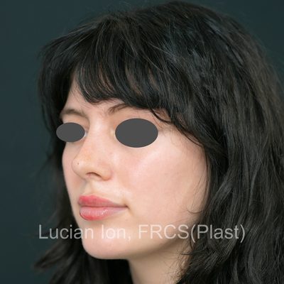 After , case 7, oblique view