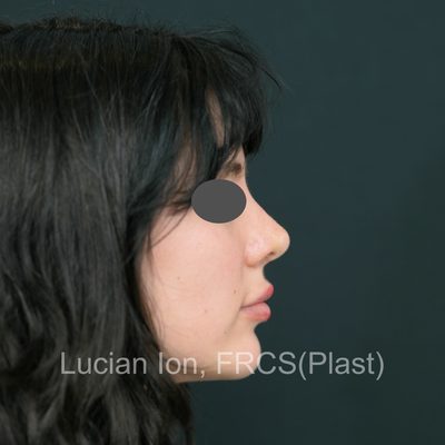 After , case 7, profile view