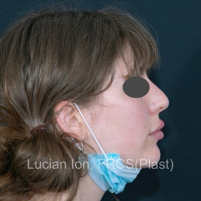 Before , case 7, profile view