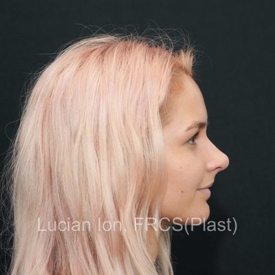 After , case 9, profile view