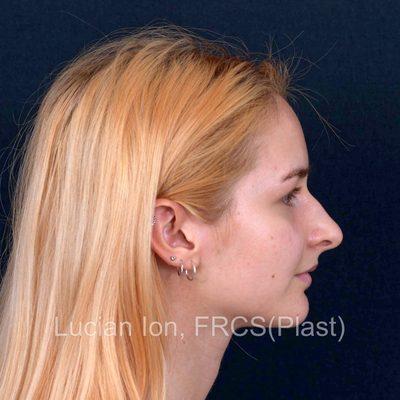 Before , case 9, profile view