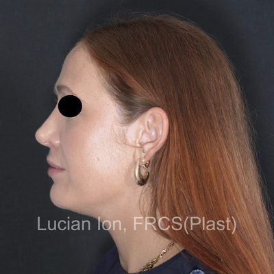 After , case 10, profile view