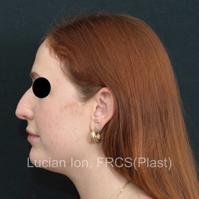 Before , case 10, profile view